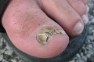 Comment Soigner Les Mycoses Des Pieds?