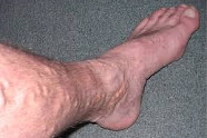 Comment Soigner Les Varices Aux Pieds?