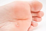 Comment Soigner Une Verrue Au Pied?